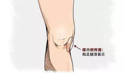 鹅足腱滑囊炎的康复治疗