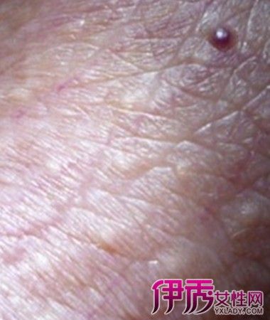 【图】阴囊毛细血管角化瘤要怎样治疗 要采取的治疗措施