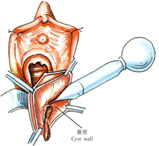前庭大腺囊肿造口术