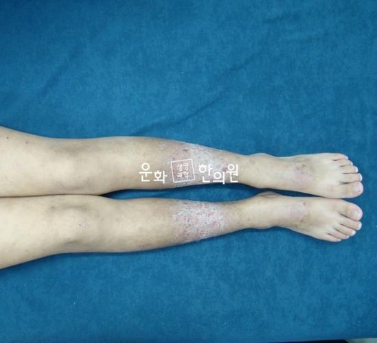 [转载]重症异位性皮炎