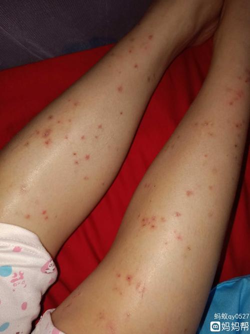 怀孕5个月.脚上长了这些疹子,晚上睡觉很