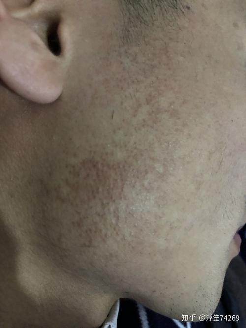 男生脸颊两侧长满了红色的斑点/痘痘,很小一颗,但是一