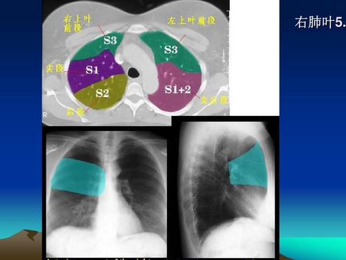 文档网 所有分类 医药卫生 临床医学 ct正常彩色解剖图-肺段 肺ct正常