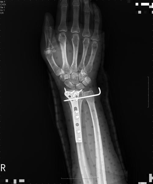 右桡骨远端骨折