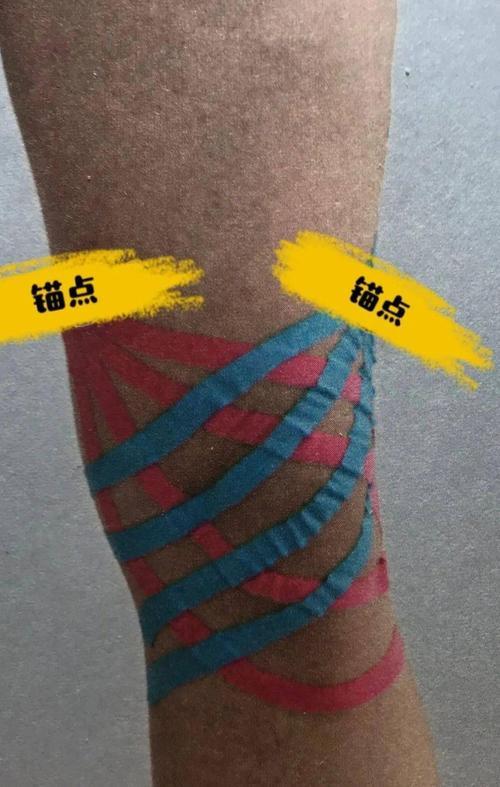 【医文医话】李本皓:膝关节肿痛试试肌内效贴