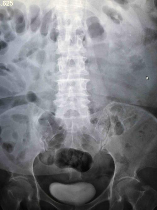 腹部平片显示肠道内积气.腹部增强ct检查发现下腔静脉血栓形成!