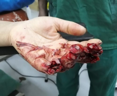一例多指严重割草机伤的治疗