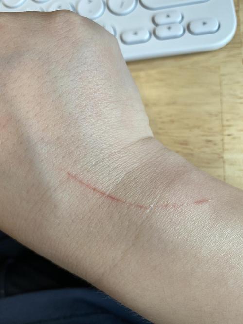 【讨论】昨天被自家猫崽子爪子抓伤了,有没有事?