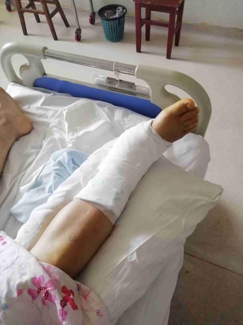 脚腕骨折,脚后跟挫伤,算几级伤残