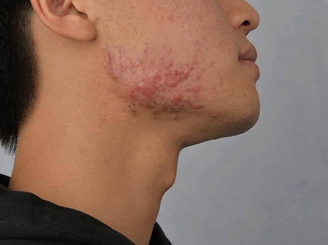以前青春期长痘导致我两边下颌处各有一片的痘疤增生,_圈子-新氧美容