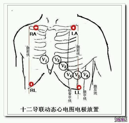 动态心电图