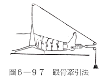 跟骨牵引法,助手固定踝部及足背,在局麻及无菌操作下,向跟骨(取内踝至