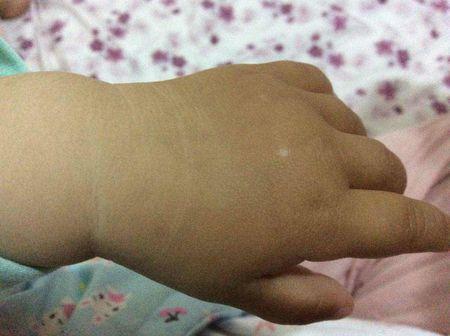 宝宝手背上最近发现多了两个白色斑点,很担心是不是什么皮肤病,很担