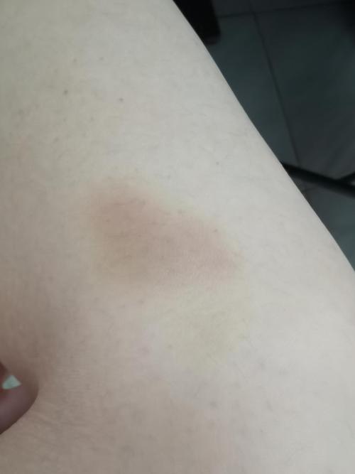 发疯中插 罗一舟老婆们我一觉醒来腿上多了好多淤青是