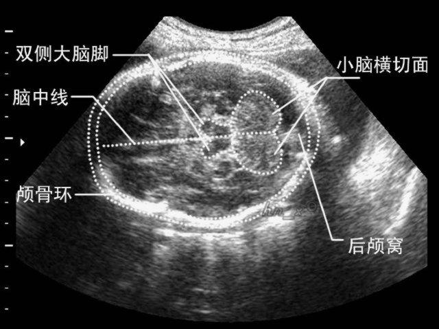 切面,见图3-2-22;②透明隔和尾状核切面,见图3-2-23;③丘脑冠状切面