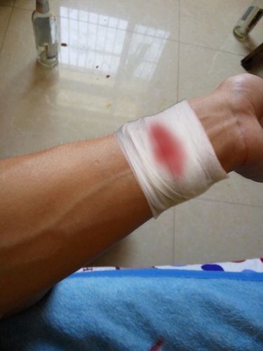求大神帮p一张手腕受伤包扎的图片.包扎图到手腕那里就行.