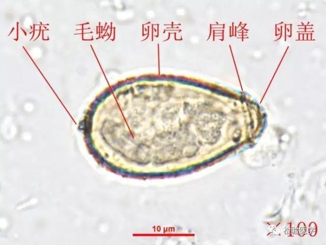 大便中发现这个东西!这到底是肝吸虫卵还是灵芝孢子?傻傻地分不清