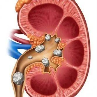 龚旻教授:泌尿系结石不痛不处理,切莫引起肾积水影响肾功能