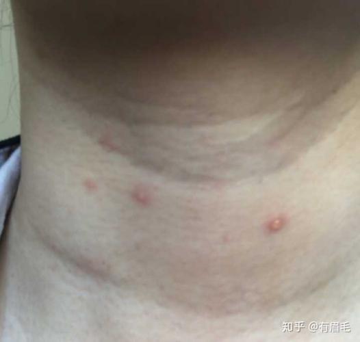 长水痘是一种怎么样的体验