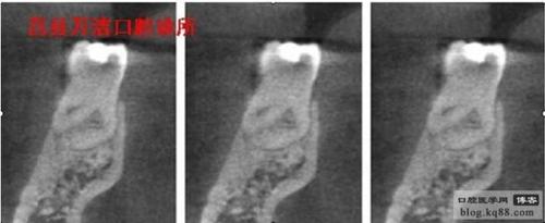 [转载]揭秘下颌第一磨牙远舌根/莒县-牙医