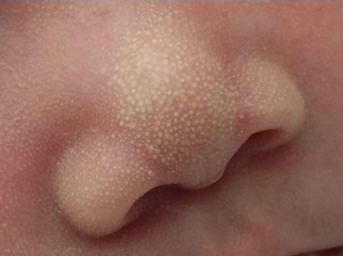 育儿知识 初生婴儿鼻子上怎么有很多小白点,如何解决 其实这些粟粒疹
