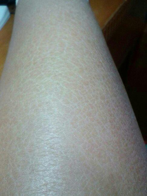 到秋冬季皮肤特别干燥,然后就会这样……不知道是不是鱼鳞病.