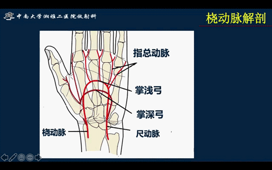 远端桡动脉入路
