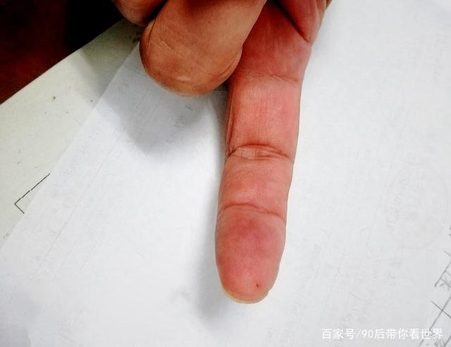 江苏宜兴一女士被蝙蝠咬了,注意:被蝙蝠咬了必须这样处理!