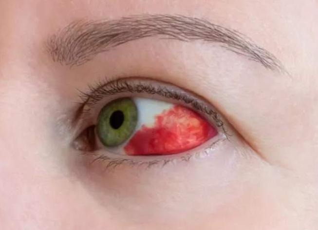 眼睛突然出血怎么回事