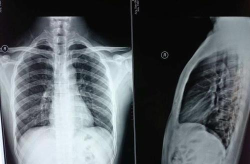 女生普遍都不愿做"胸透",究竟是为什么?女医生脸微红说出实话