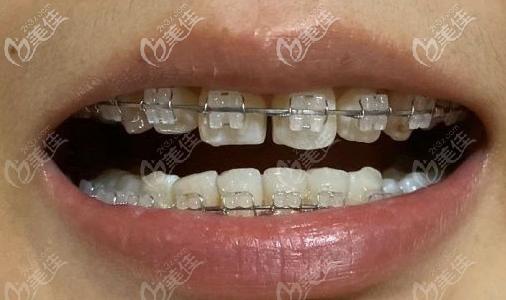 陶瓷半隐形矫正牙套和隐形牙套的价格相差的多吗?