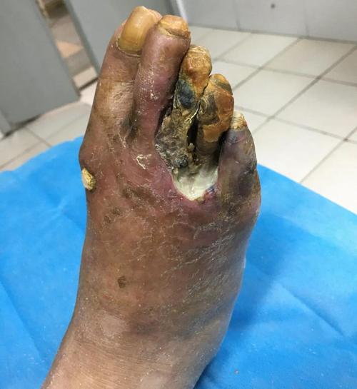 降温啦如何避免糖尿病足