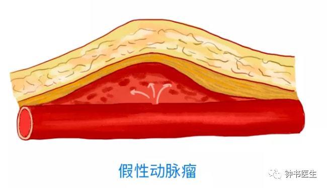 颅内动脉瘤常见的类型有哪些