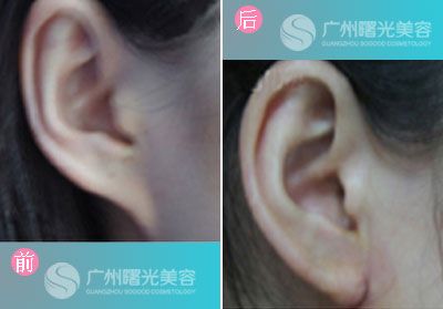 自体脂肪丰耳垂