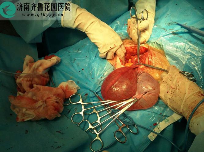 特大卵巢囊肿手术病人顺利出院 患者送锦旗表达感谢