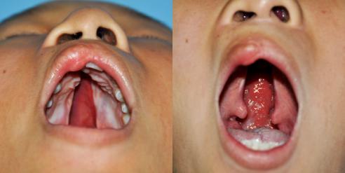 13岁女孩重度唇腭裂 口齿不清渴望自然微笑