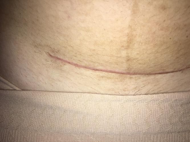剖腹产两个月,疤痕这样,请问正常吗?