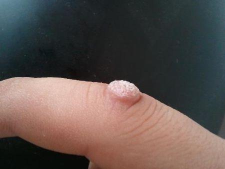 手指上长了个硬肉球