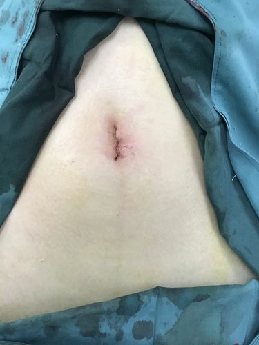 单孔腹腔镜术后皮肤伤口疤痕在肚脐处,待完全愈合后几乎可以说是"