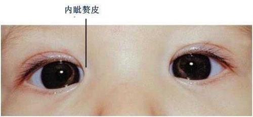 厦门眼科中心小儿眼科潘美华主任表示,真性内斜视2岁内可采取手术