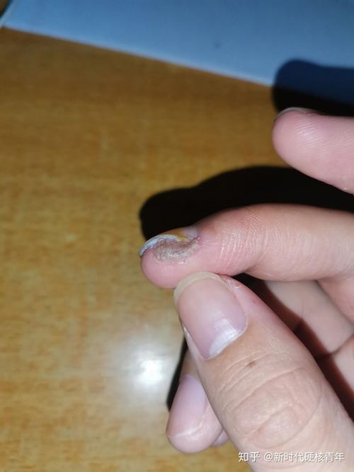 最真实的一次治疗寻常疣(甲周疣)经历