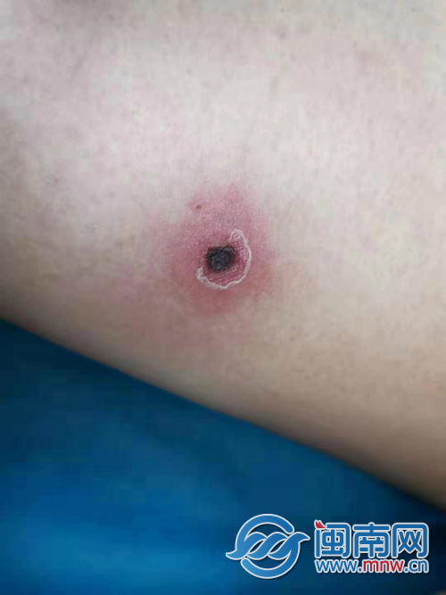 漳州一女子染上恙虫病 在诊所治疗无效险些危及生命