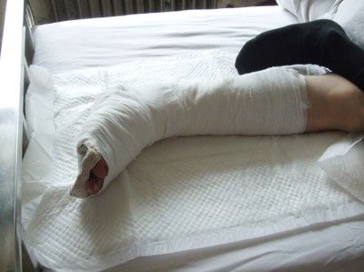 骨折患者要注意哪些饮食禁忌 介绍5款食疗方加快骨折恢复