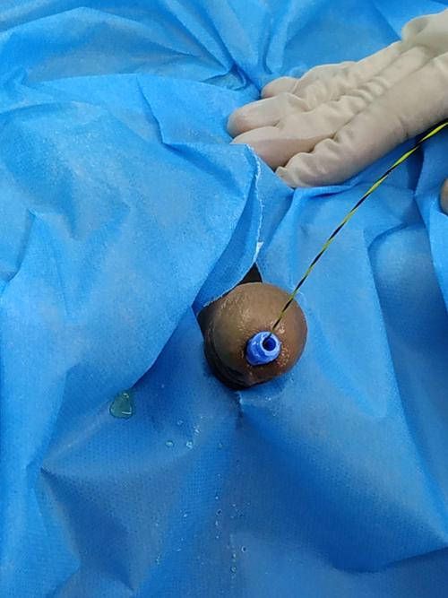 尿道狭窄导丝扩张中