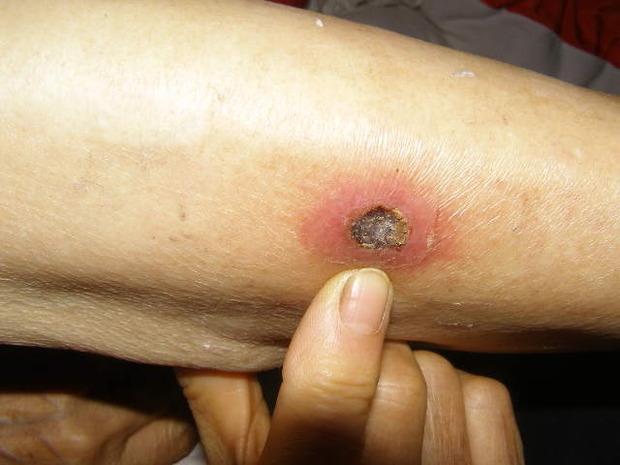 小腿生疮还发烧是什么病