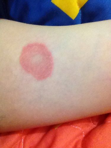 环形红斑会有母斑吗?癣会有母斑吗?本人皮