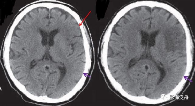 夜班不求人急性脑梗死的ct诊断