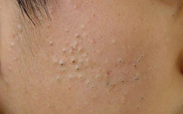 闭合粉刺一定要挤出来才会好吗闭合性粉刺挤出来会好吗图