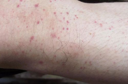 皮下出血点 通过仔细询问病史,老人自述曾有轻度脑梗,经过住院治疗