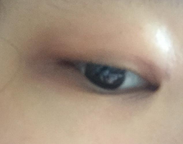 眼睛下方的是泪沟还是眼袋?